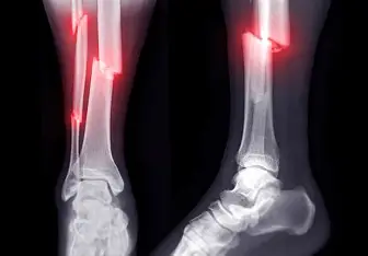 Fracture Treatment